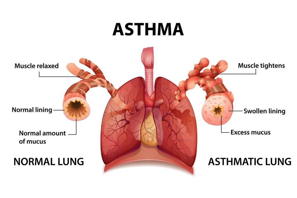 what is asthma