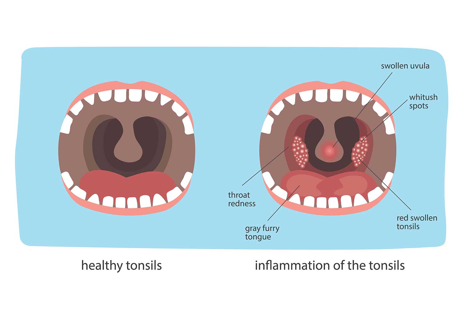 Strep Throat Causes Symptoms - Angleton ER No Wait 24/7